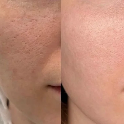 Antes y después: textura y poros más refinados